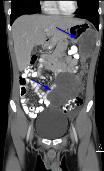 Figure 6 (left): 27 year old male with Desmoplastic Small Round Findings: Abdominal CT revealing at least two large hypodense, lobular abdominopelvic omental masses.