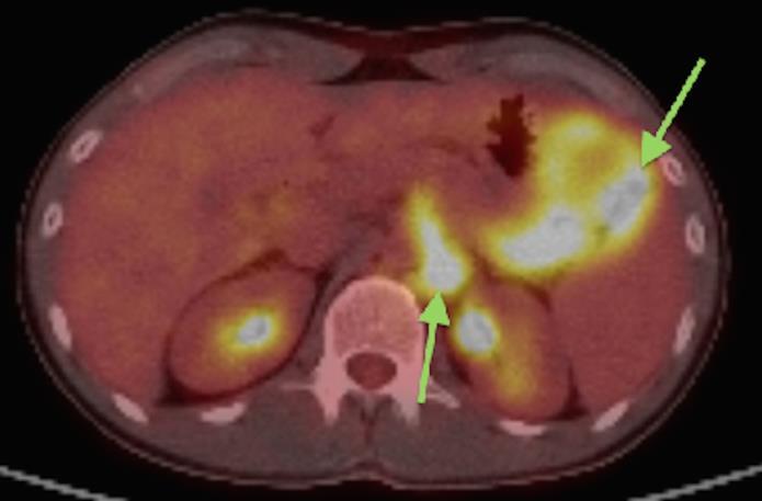 Technique: Coronal, intravenous (IV) and enteric contrast Figure 7: 27 year old male with Desmoplastic Small Round Findings: PET/CT with FDG avid metabolic foci in the