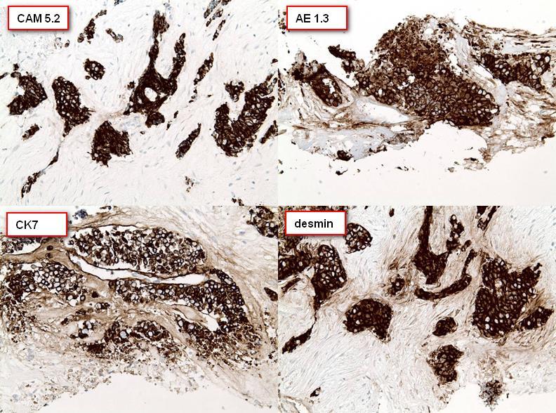 Figure 9: 27 year old male with Desmoplastic Small Round Findings: A panel of immunohistochemical stains were performed which revealed positive staining of the malignant cells for cytokeratins CAM 5.