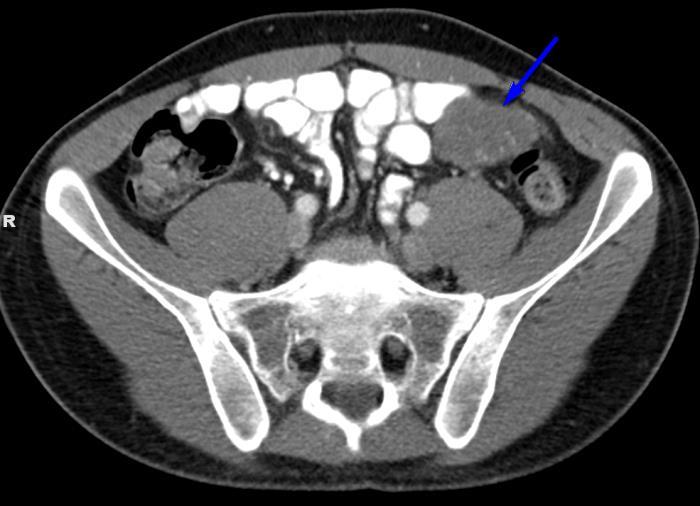 Figure 10: 27 year old male with Desmoplastic Small Round Findings: Abdominal CT revealing a low density soft tissue mass (blue arrow) in the left midabdomen abutting but not obstructing the small