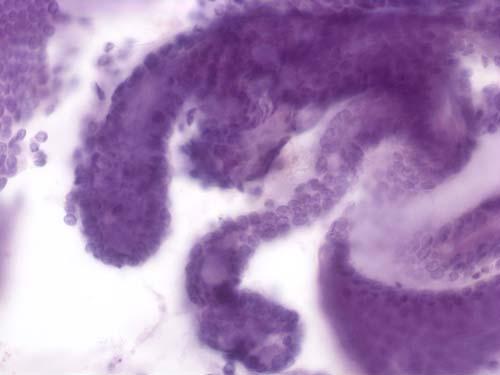 Cytological Analysis of Cyst Fluid Challenges Scant fluid Low to no