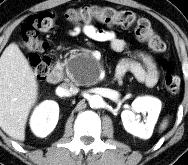 Pancreatic Pseudocyst Clinical Most common cystic lesion in the