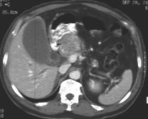 present most tumors are microcystic with multiple, <2cm cysts, but can be unilocular due to