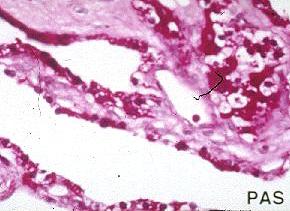 histology: small cysts lined
