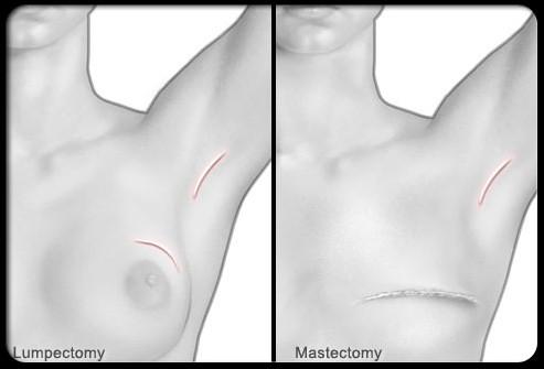 Breast Cancer Surgery There are many types of breast cancer surgery, from taking out the area around the lump (lumpectomy or breast-conservation surgery) to removing the entire breast (mastectomy.
