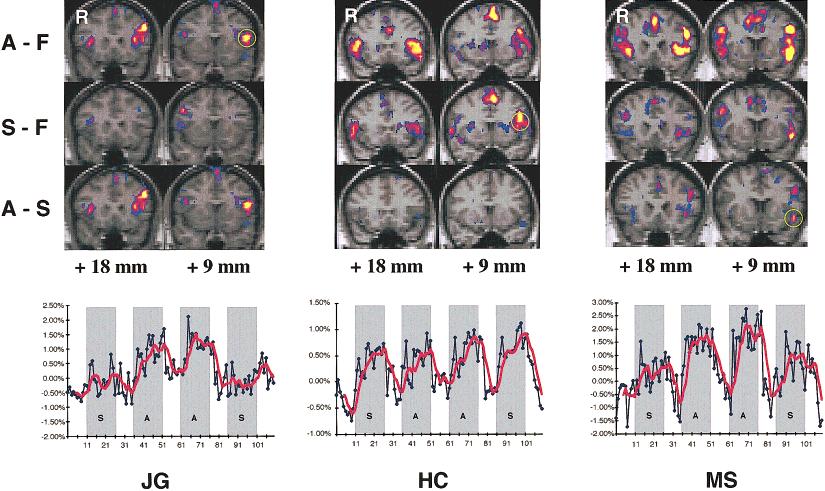 fmri of Auditory and Visual Word Processing Figure 5. KS maps and corresponding time courses of 3 subjects, showing variations in activation of the left inferior frontal region according to task.