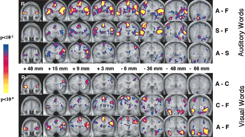 Chee et al. Kolmogorov-Smirnov (KS) maps of brain activations in selected regions. Numbers represent distance along the anterior-posterior direction in Talairaich space.