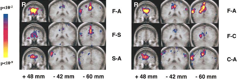fmri of Auditory and Visual Word Processing Figure 4. KS maps of regions more active during fixation compared to active tasks. F, fixation; A, Abstract/ concrete; S, Syllable; C, Case.