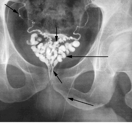 SPERMATIC CORD Collective name for structures associated with the scrotum Passes through inguinal canal Includes Vas Deferens Testicular Arteries + Veins