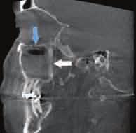 (FOV) CBCT machines. Many of these findings will also be seen in smaller FOV machines when the volume capture is moved around to view things like the temporomandibular joint or third molar regions.