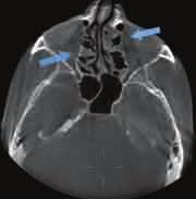 ) Axial view showing ethmoid air cell opacification seen in a. (c.&d.