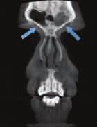 ) Axial view showing ethmoid air cell involvement in uniform thickening in sphenoid