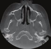 ) Bilateral involvement of the frontal sinuses in an axial view. (e.