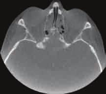 ) Thin slice coronal sections showing bilateral maxillary sinus involvement and