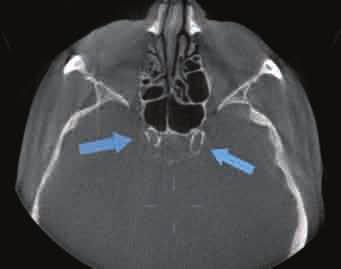 ) A possible mucocele or pyocele in the superior ethmoid air cell complex.
