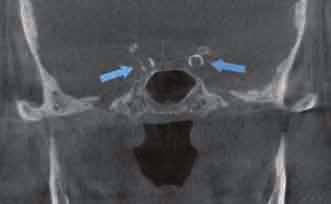 ) Bilateral calcification of the internal carotid arteries on each side of the sella just posterior to the sphenoid