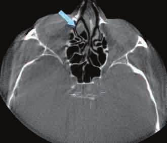 ) The same calcifications as they loop anteriorly seen just superior to the sphenoid sinus and below the anterior