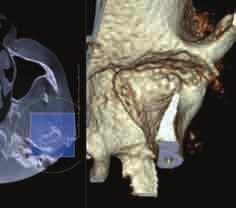 predominantly sagittal view. Figures 20a-c demonstrate this pitfall. Conclusions Relatively common pathologic findings have been reviewed for the anatomic area seen in large FOV CBCT machines.