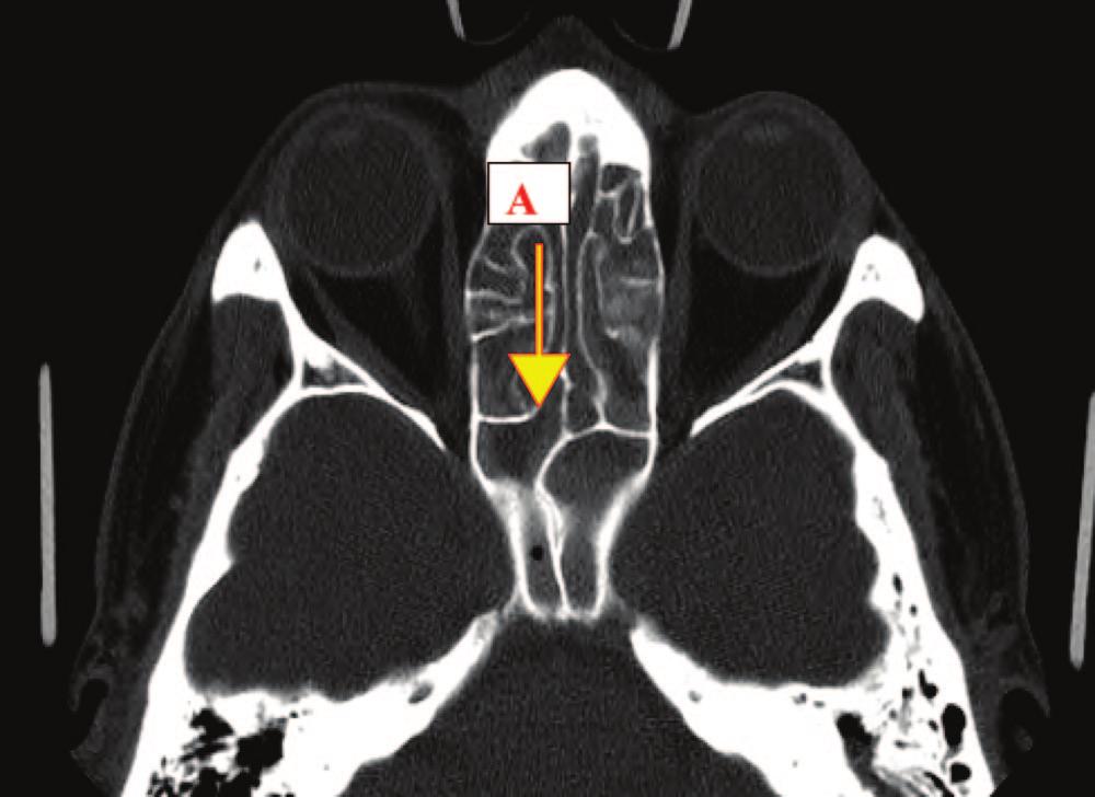 Figure 1. Axial computed tomography cut at the level of sphenoid natural ostium showing type A superior turbinate attachment. Figure 4.