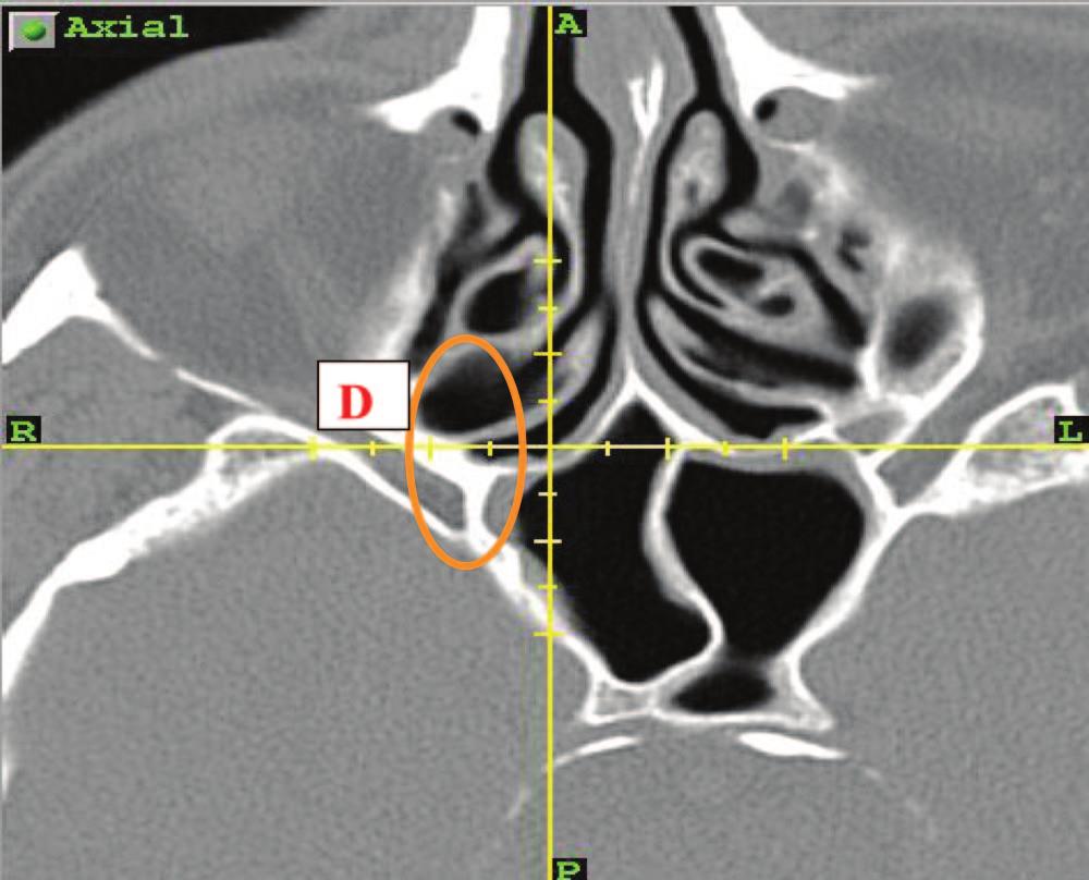 Axial computed tomography cut at the level of sphenoid natural ostium showing type B superior turbinate attachment. Sphenoid Face and Entry Type Left Side (Table 3).