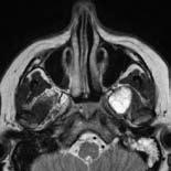 T2w SENSE T1w fat suppressed 3D T2w DRIVE 3D T2w DRIVE T1w TSE Left cranial nerve V schwannoma. Scanned with skull base ExamCard. Right cochlear nerve schwannoma. Scanned with IAC ExamCard.