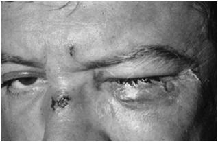 Open Globe Injuries In the United States alone ~ 2,500,000 eye injuries per year United States Eye Injury Registry(USEIR) was established in 1988 Goal is