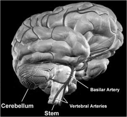 Aneurysmal Third-Nerve Palsies 90 % of aneurysmal third-nerve palsies have the pupil