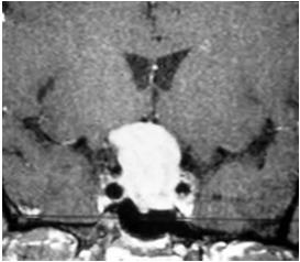 variable with diabetic 3 rd Acute = aneurysm or ischemic vascular Progressive = infiltrative or compressive Treatment: Referral to Neuro-Ophthalmologist immediately Possible MRI / MRA / CT Catheter