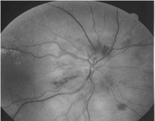 Must be differentiated from Non-Arteritic AION Sudden painless loss of vision Females > Males ( 2:1 ratio ) Patients usually > 55 years of age NAION AION Etiology Occlusion of the short posterior