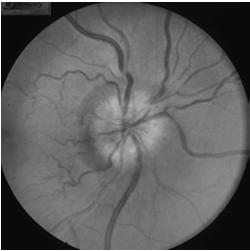 optic nerve head with flame shaped hemes Central retinal artery occlusion may occur Cranial nerve palsy (CN 3,4,6) may also be present, CWS Presentation: Systemic Headache Scalp tenderness Jaw