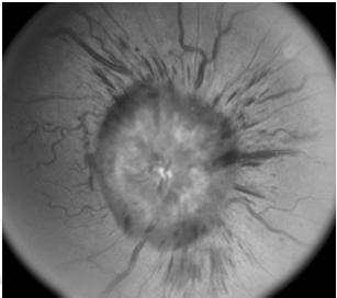 The One Third Rule in Giant Cell Arteritis 1/3 of optic nerves in the fellow eye will become infarcted within 48 hours in untreated patients.