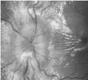 Second eye infarctions are rare after more than 1 month Malignant Hypertension defined as Blood Pressure > 210/120 Ocular Presentation: General Rule: Disc edema with or without exudate Arterio venous