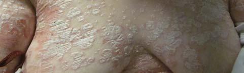 31 Atopic Dermatitis (AD) The prevalence of AD is between 15-20% of toddlers and school aged children