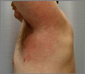 Contact Dermatitis Nickel Most common cause of chronic allergic contact dermatitis (up to