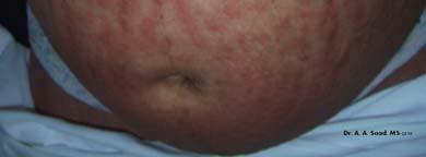 Specific Pregnancy Dermatoses: 1. Polymorphic Eruption of Pregnancy (PUPPP, toxemic rash of preg, toxic erythema of preg, lateonset prurigo of preg) 2.