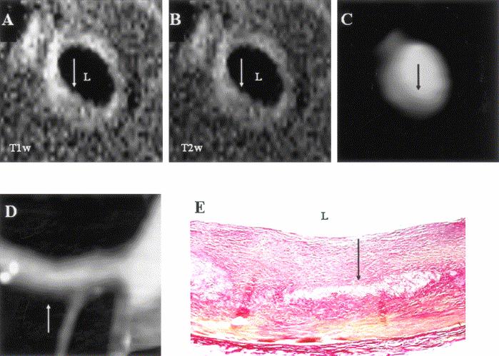 Ex-vivo coronary fibro-atheroma by MR & CT
