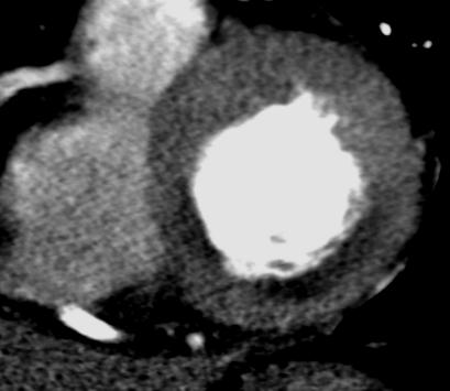 CT After Myocardial Infarction Post-thrombolysis Coronary angiography Patency IRA Additional lesions