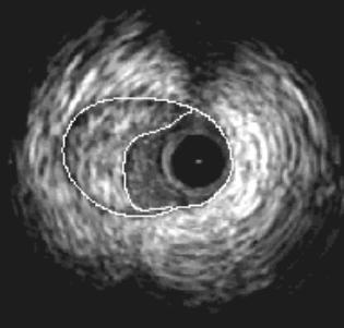 IVUS (mm²) 2 ) Luminal CSA (100) CT 13.6 ± 8.3 mm 2 US 12.9 ± 8.0 mm 2 Mean difference: 0.6 ± 3.