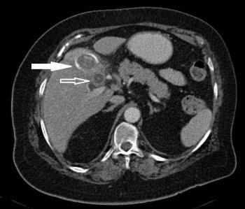 adenocarcinoma of the duodenum and pancreas; GIST; lymphoma; metastasis); Benign mass (gastric bezoar); Inflammatory disorder (peptic disease; Crohn's disease), Causes of pneumobilia: Infectious