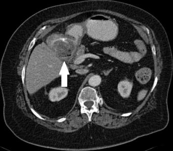 Contrast-enhanced CT image obtained caudal to A shows pneumobilia in a partially contracted gallbladder.