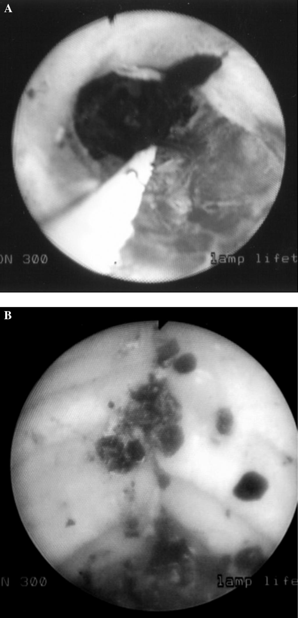 Percutaneous Endoscopic Holmium Laser Lithotripsy for Management of Complicated Biliary Calculi, Healy K et al antegrade passage of a Fogarty balloon over a guide wire into the duodenum to expel any