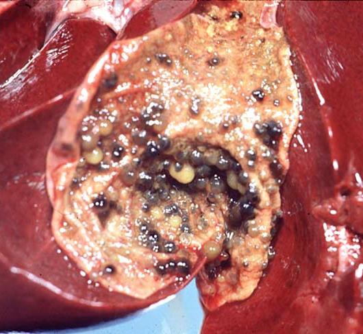 Cystic Mucinous Hyperplasia Cystic proliferation of the