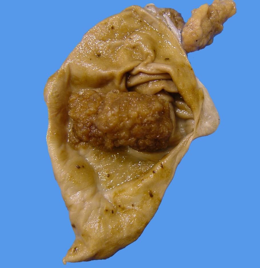 carcinoma with