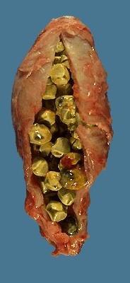 Gallstones Natural History 80% of patients, gallstones are clinically silent. 20% of patients develop symptoms over 15-20 years About 1% per year.