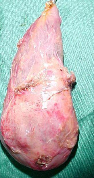 Empyema / Mucocoele Empyema refers to a gallbladder filled with pus due to acute cholecystitis.