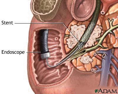 Stent Placement A catheter is inserted through the endoscope into the ostium of the common bile duct.