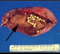 Gallstones Types of gallstone Cholesterol stones (20%) Pigment stones (5%) Mixed (75%) Epidemiology Fat, Fair, Female,