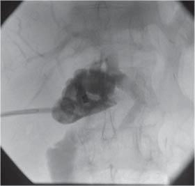 bile leakage over five days, and then the drainage catheter was successfully