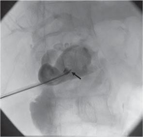 All coexistent common bile duct stones were successfully A B C D Fig. 3.