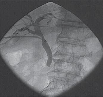 Fragmented stones were extracted through 12-Fr sheath. D.